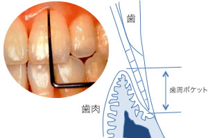 歯周ポケットの測定