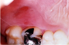 歯周治療による歯肉の変化：初診時