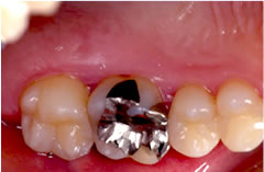 歯周治療による歯肉の変化：3か月経過