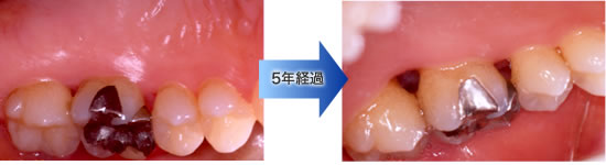 歯周治療による歯肉の変化：1年10ヵ月経過