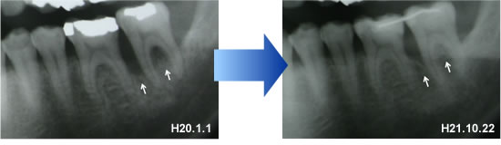 歯周治療による骨の変化