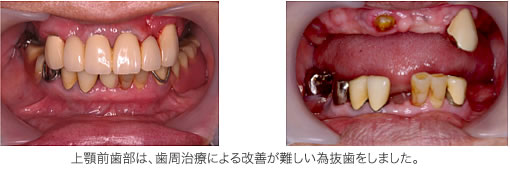 糖尿病と歯周病