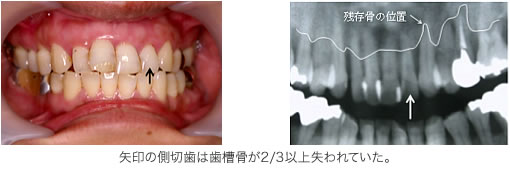 妊娠と歯周病